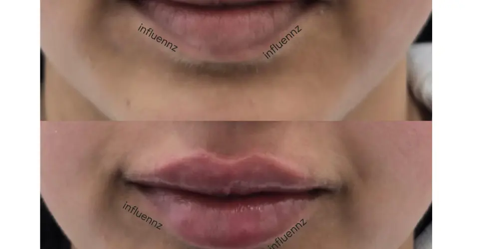 Lip Pigmentation Laser treatment in Delhi