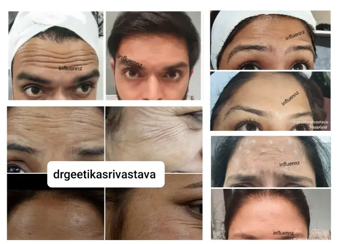 Botox before and after photos