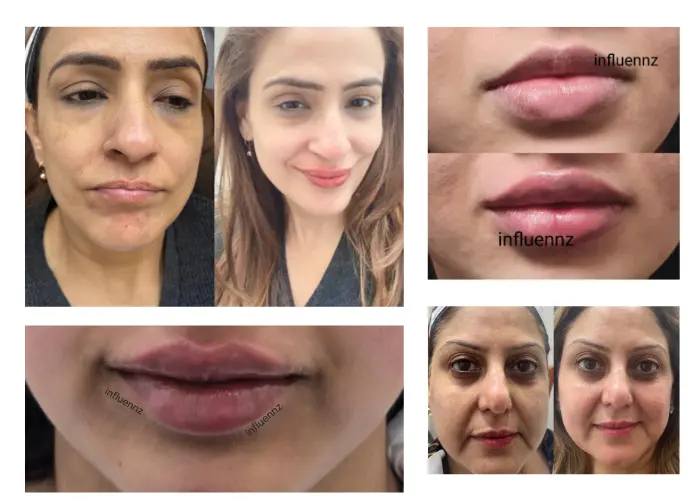 Filler before and after photos