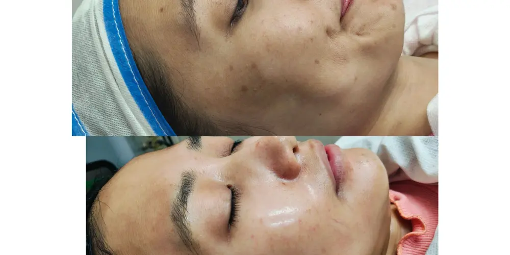 Skin Tightening Treatment for Face