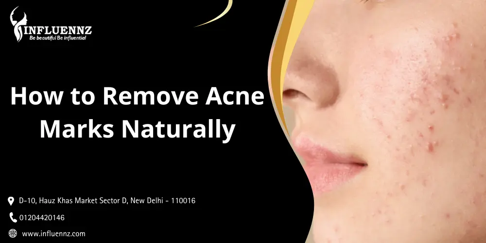 How to Remove Acne Marks Naturally