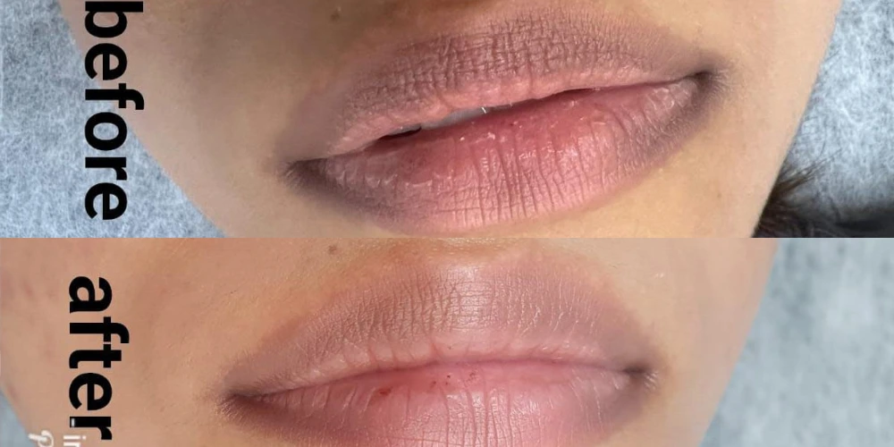 Lip Pigmentation Laser treatment in Delhi