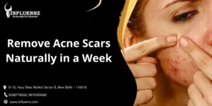 Remove Acne Scars Naturally in a Week