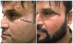 Acne scar before and after