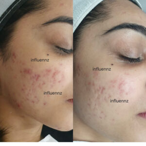 Laser Treatment for Acne Scars before and after