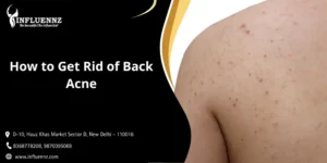 How to Get Rid of Back Acne