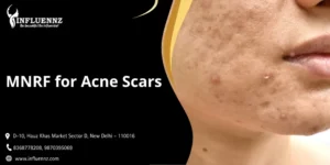 MNRF for Acne Scars