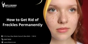 How to Get Rid of Freckles Permanently