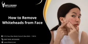 How to Remove Whiteheads from Face