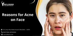 Reasons for Acne on Face