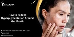 How to Reduce Hyperpigmentation Around the Mouth
