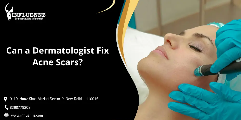 Can a Dermatologist Fix Acne Scars