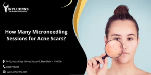 How Many Microneedling Sessions for Acne Scars
