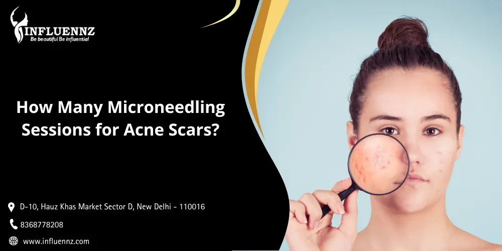 How Many Microneedling Sessions for Acne Scars