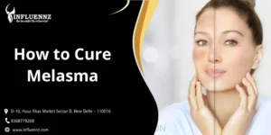 How to Cure Melasma