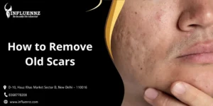 How to Remove Old Scars