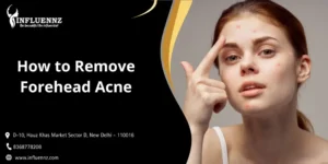 How to Remove Forehead Acne
