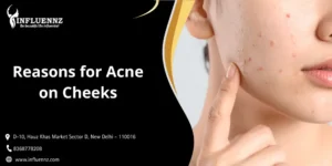 Reasons for Acne on Cheeks
