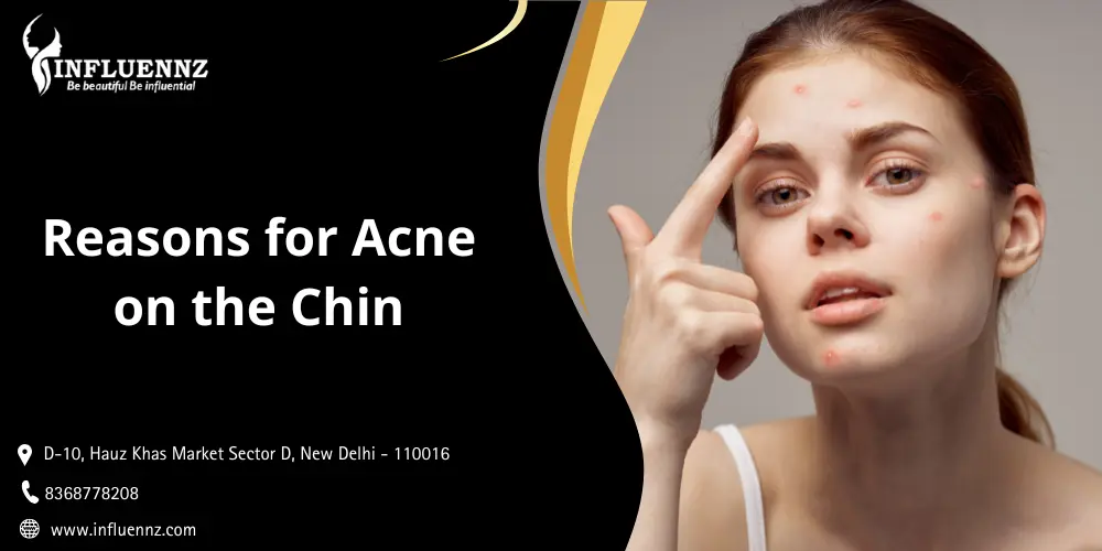 Reasons for Acne on the Chin