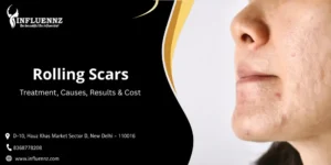 Rolling Scars Treatment