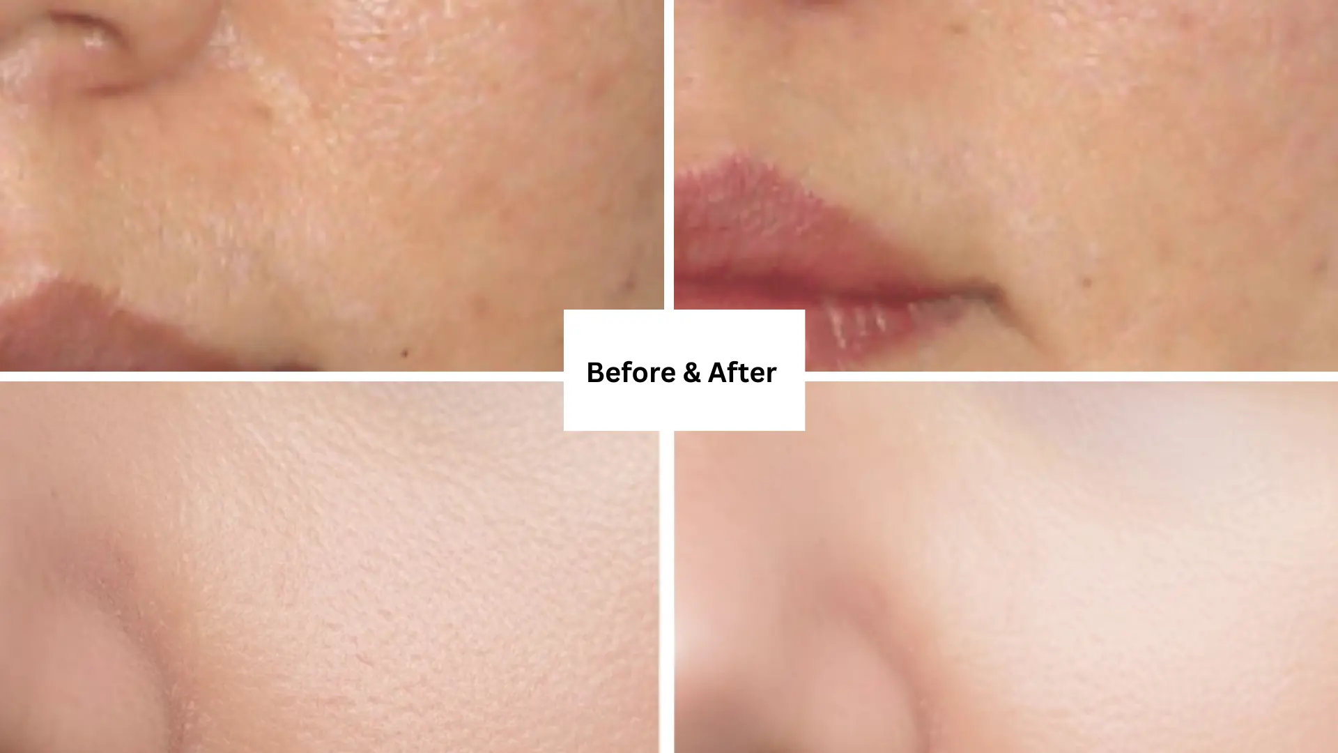 Open pores Before and After result