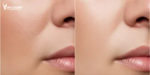 Read more about the article Treatment for Open Pores on Face by Dermatologist in Delhi