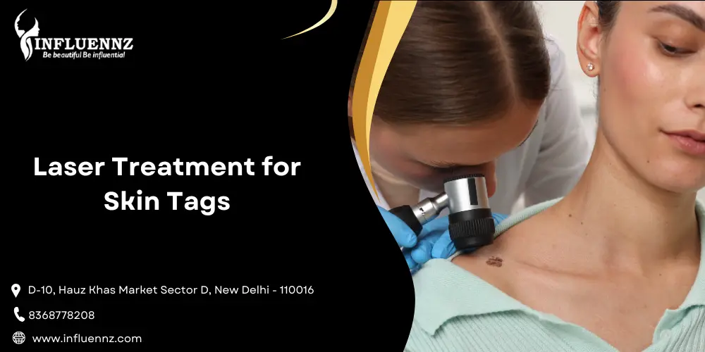 Laser Treatment for Skin Tags