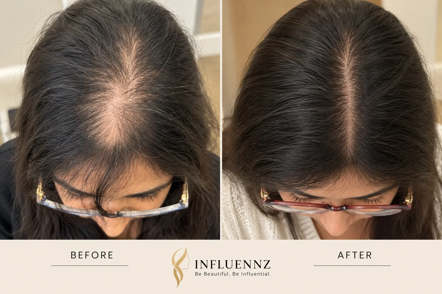 female hair transplant result