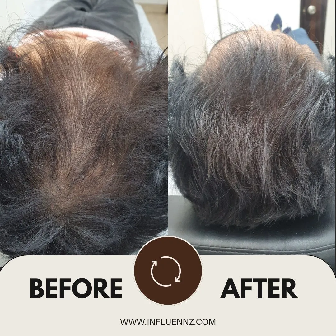 Before and After GFC therapy