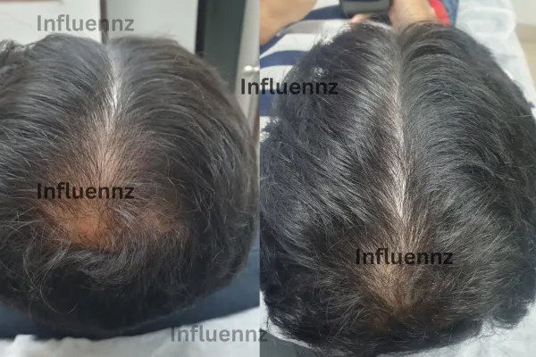 acne scar before and after