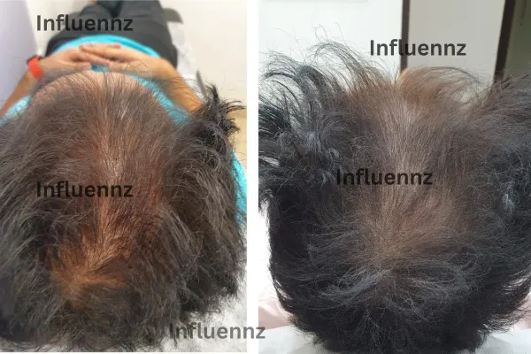 acne scar before and after result