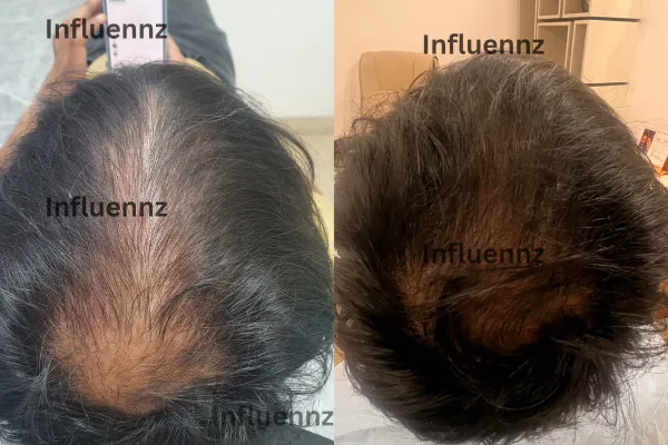 acne scar before and after