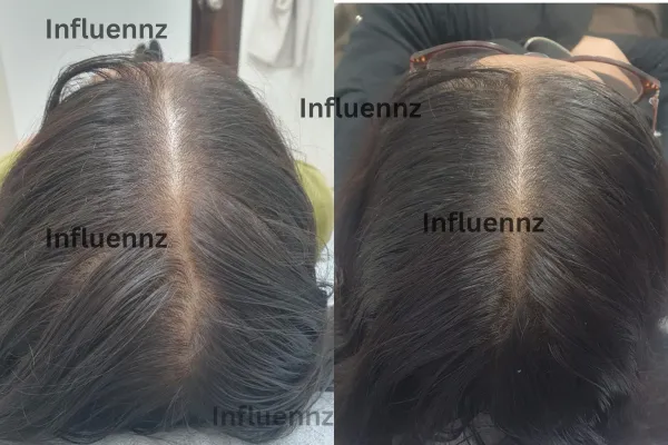 acne scar treatment result
