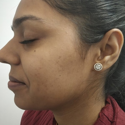 Acne Treatment