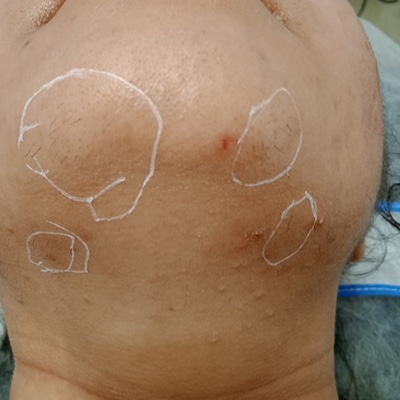 Laser treatment