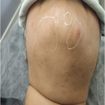 Laser treatment