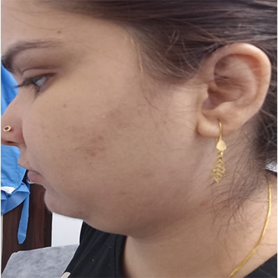 melasma treatment