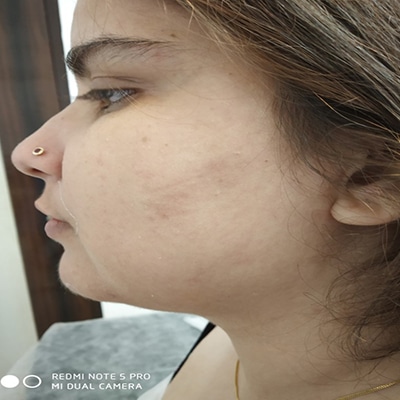 melasma treatment
