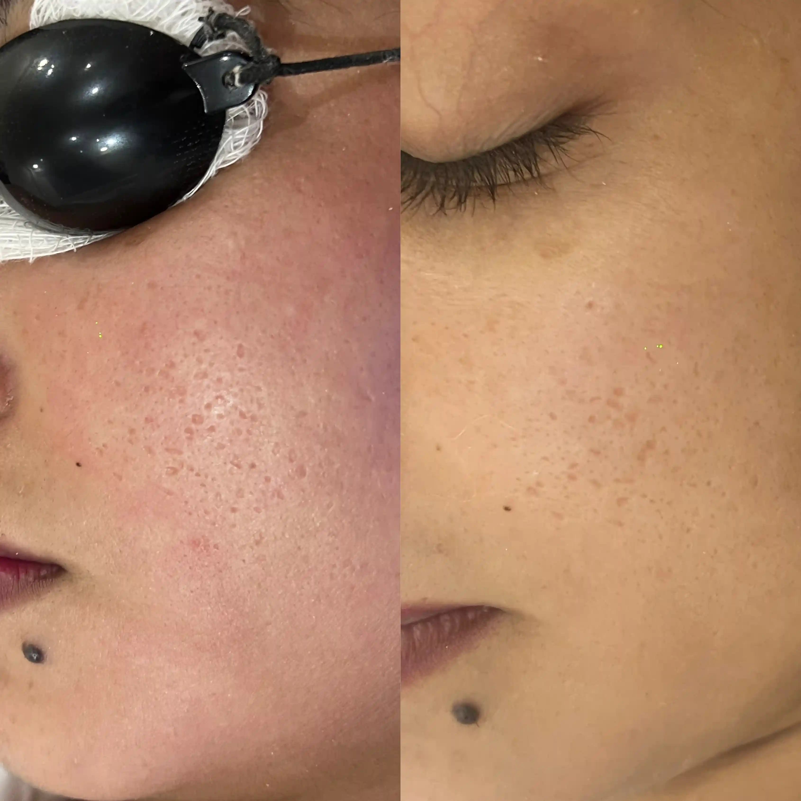 acne scar before and after
