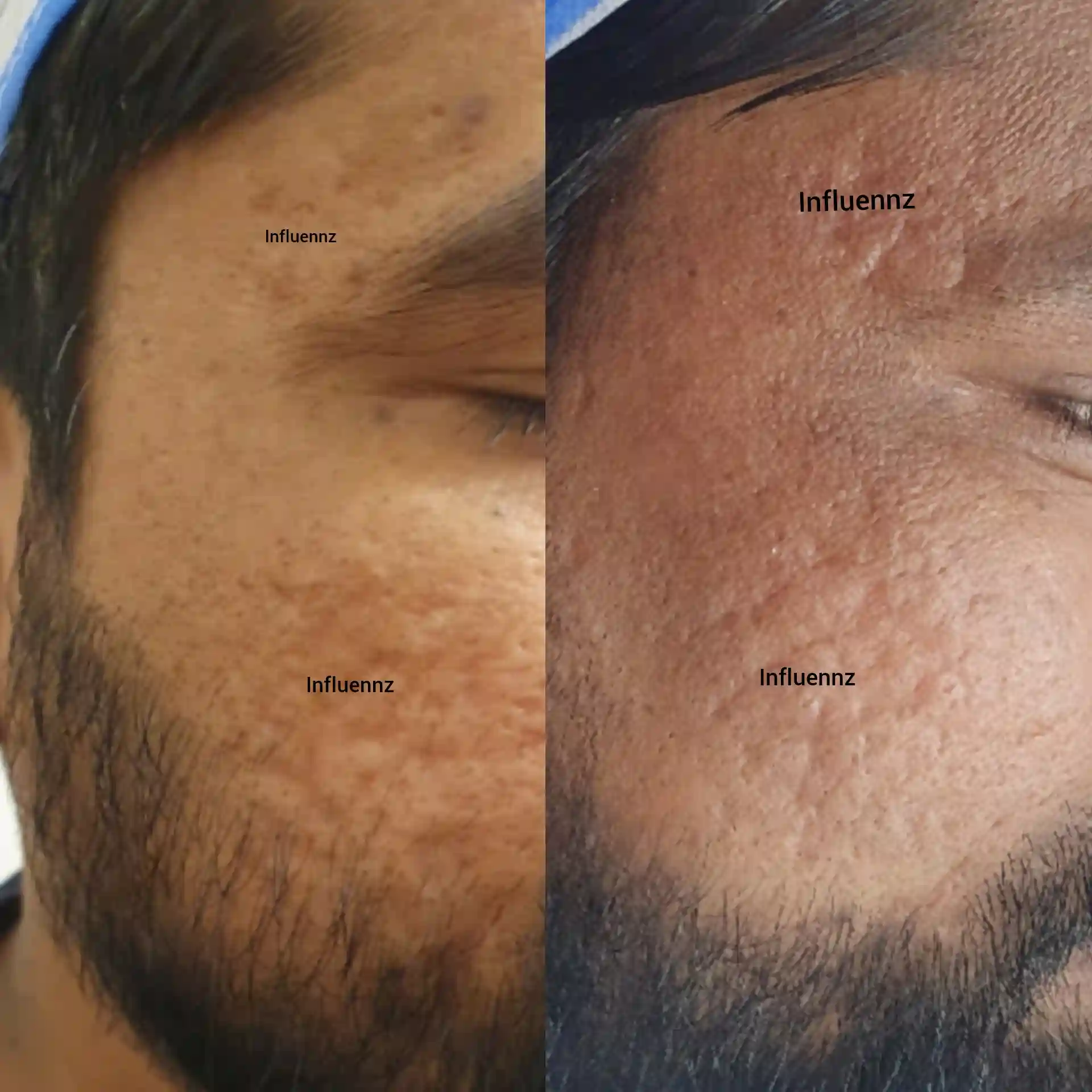 acne scar before and after result