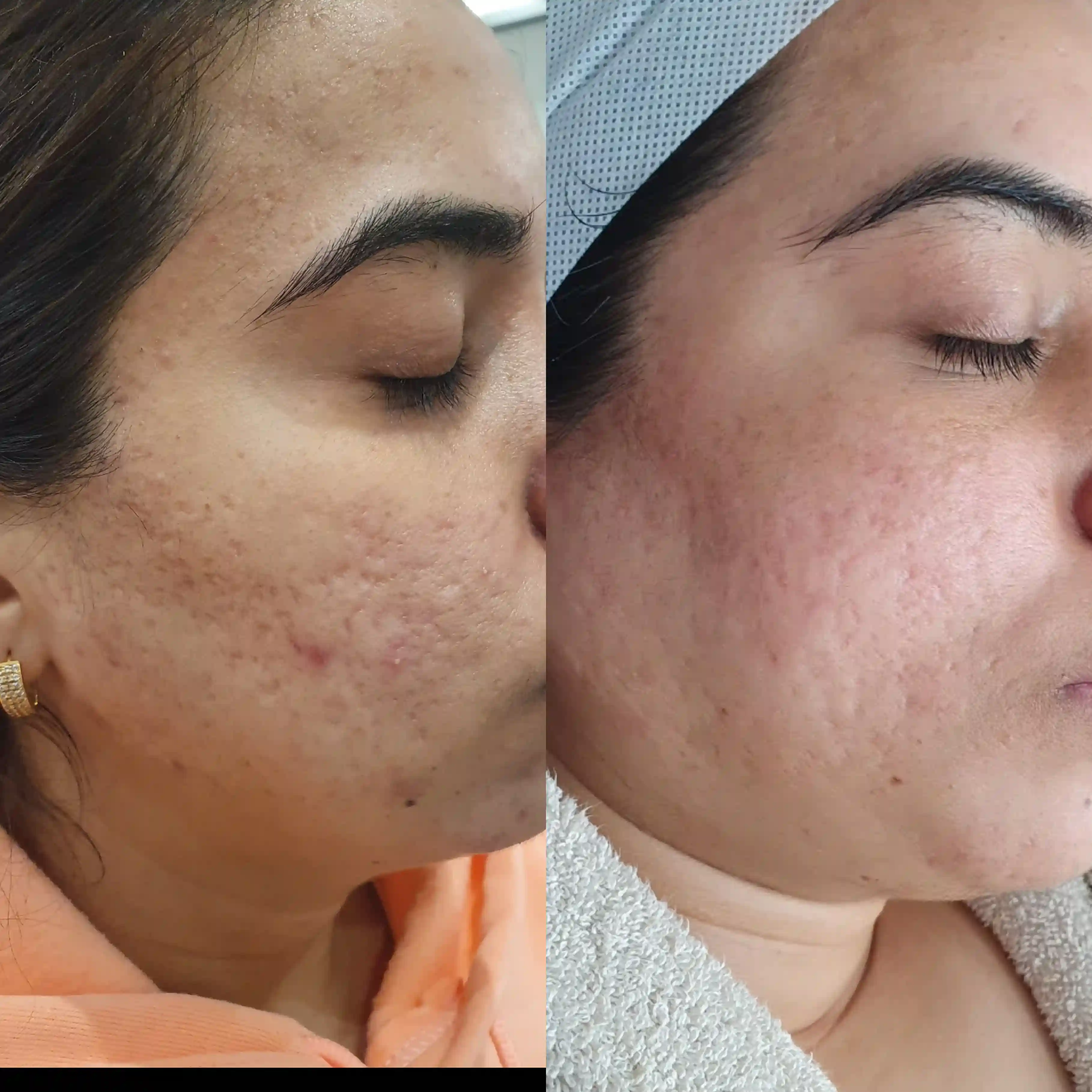 acne scar before and after