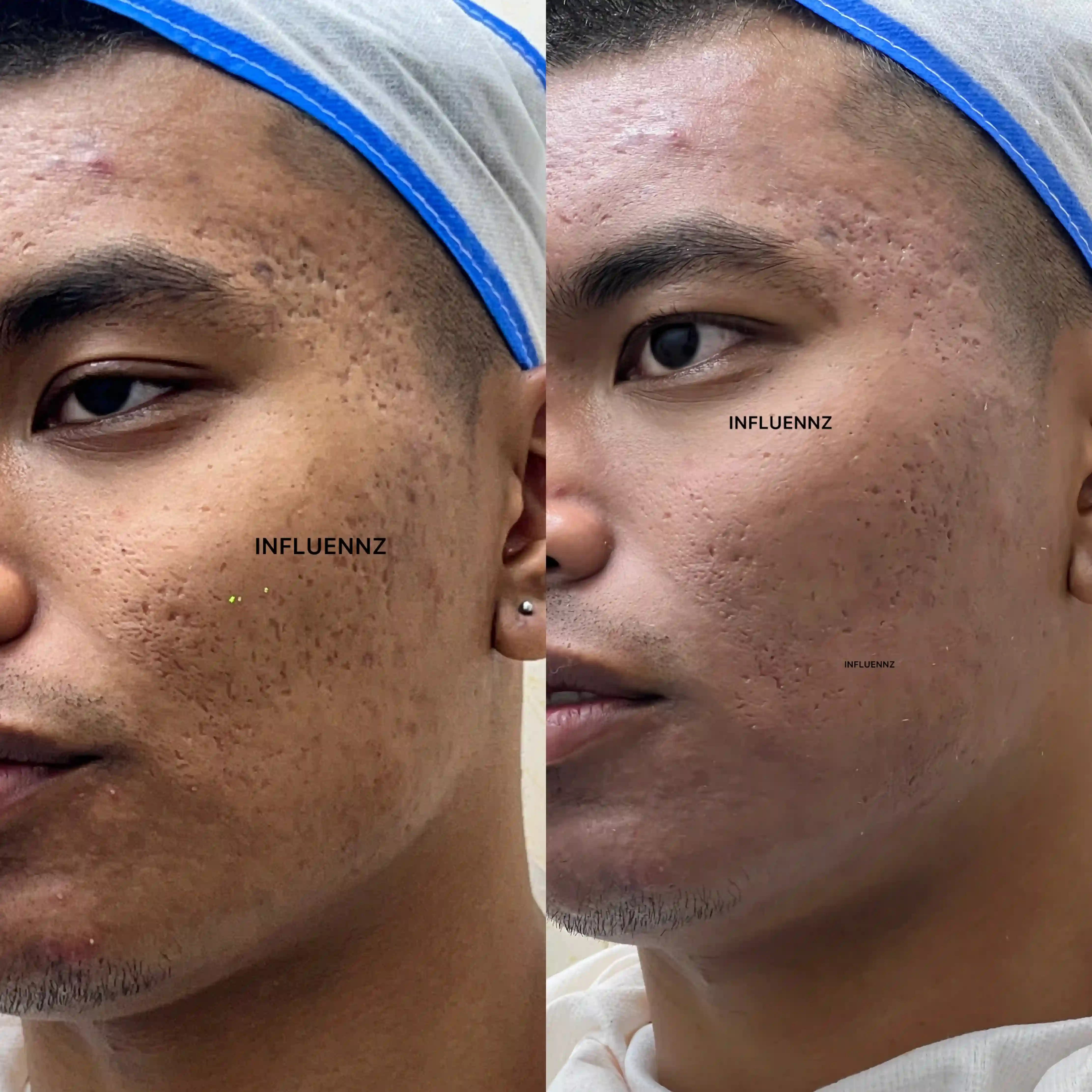 acne scar treatment result