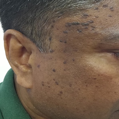 Mole Surgery