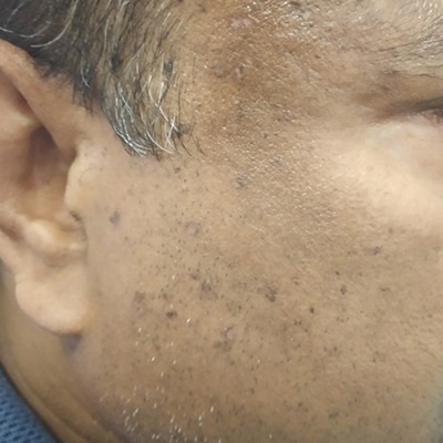 Mole Surgery