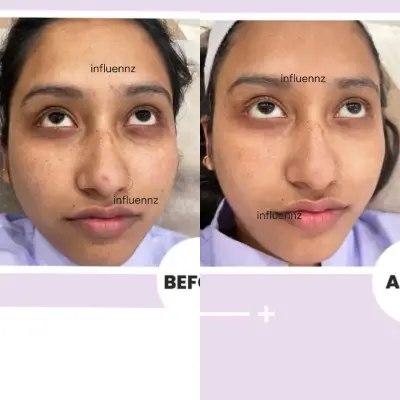 pigmentation
