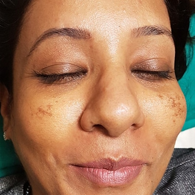 pigmentation