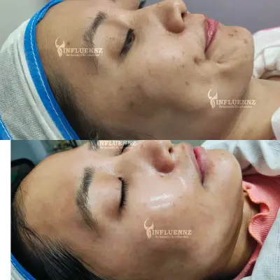 pigmentation
