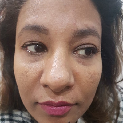 pigmentation