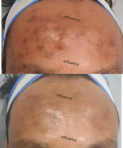 pigmentation