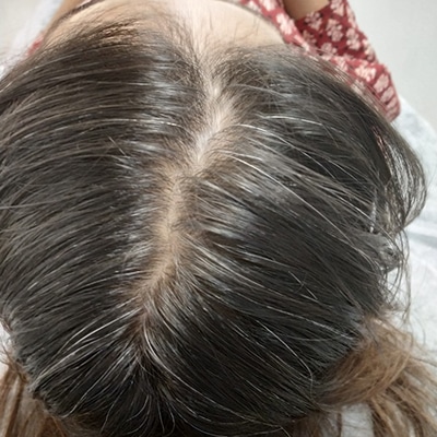 Hair Treatment